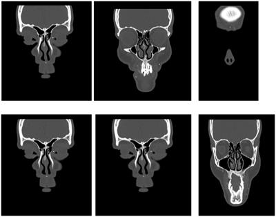 Case report: Bilateral eye injuries in members of one family due to a cluster munition in Ukraine